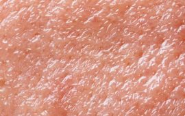 Oily skin
