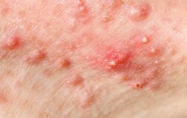 Acne Prone Skin