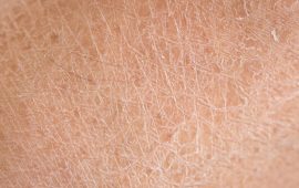 Dry Skin