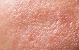 Oily skin
