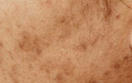 Pigmentation