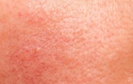 Sensitive Skin (2)